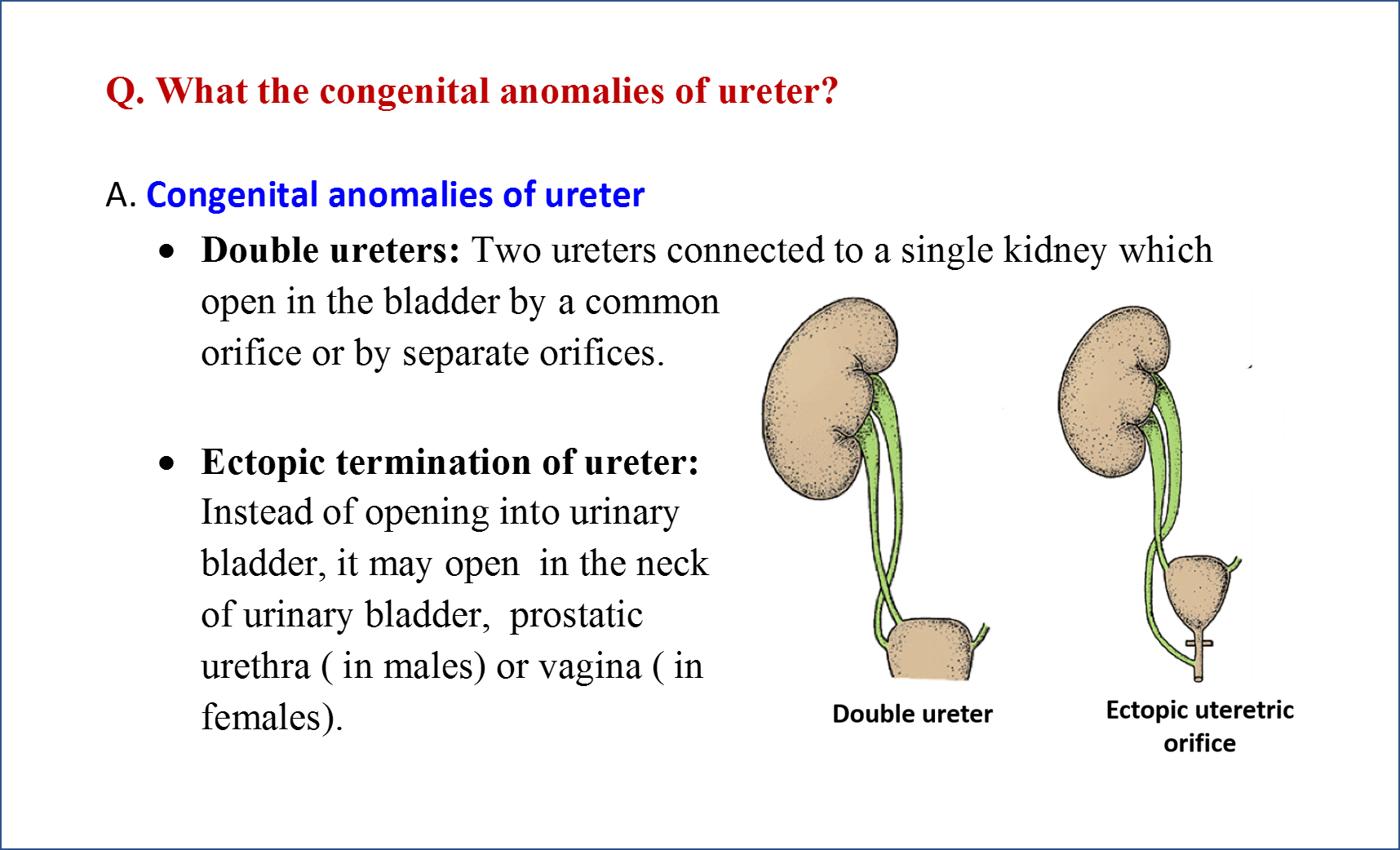 Congenital Anomalies of Ureter